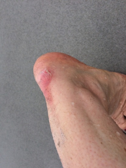 One blister after my wellbeing walk in Tasmania